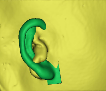 小耳畸形怎么辦？這有一份三維數(shù)字化治療方案請(qǐng)簽收！